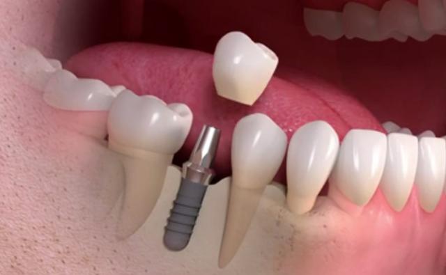 Dental Implant